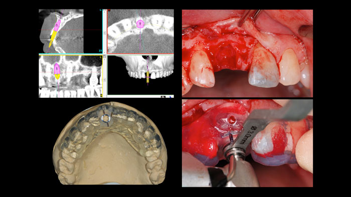 吉松歯科医院　CAD/CAM治療例2